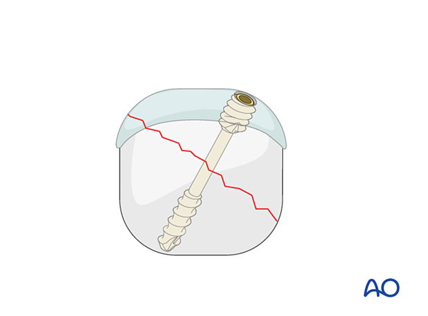 Headless compression screw insertion