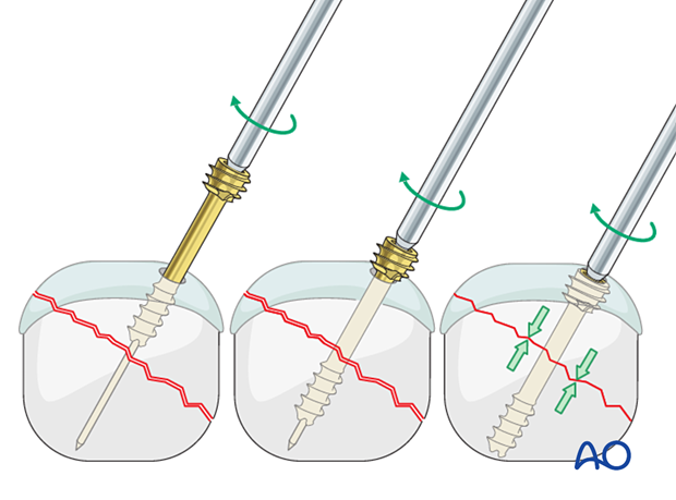 Insertion of a Herbert-type headless compression screw for compression of an articular fracture