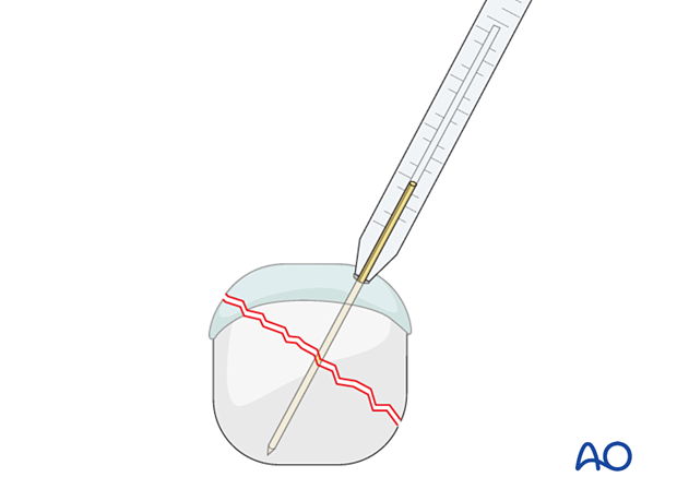 Compression of an articular fracture with a headless compression screw – Screw-length determination