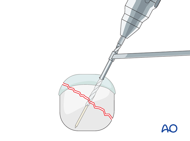 Compression of an articular fracture with a headless compression screw – Drilling