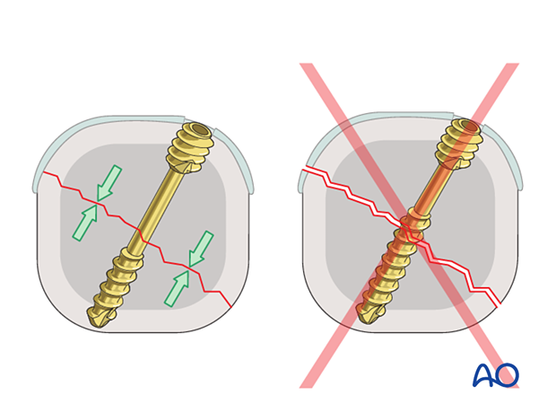 Compression of an articular fracture with a headless compression screw – Thread length of the screw tip