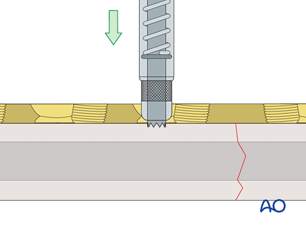 universal spring-loaded DCP drill guide