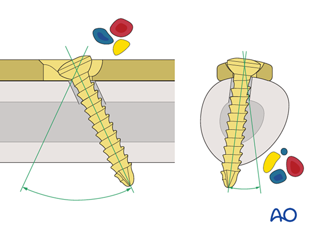 Screw angulation