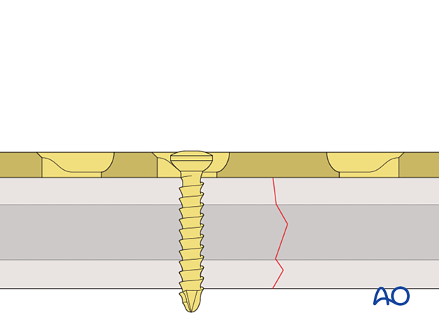 Cortical screws