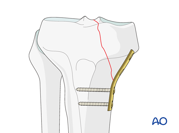 Metaphyseal screws