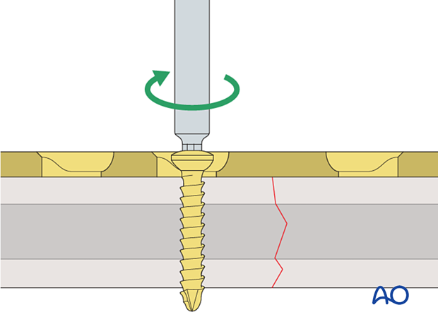 Screw insertion in neutral mode