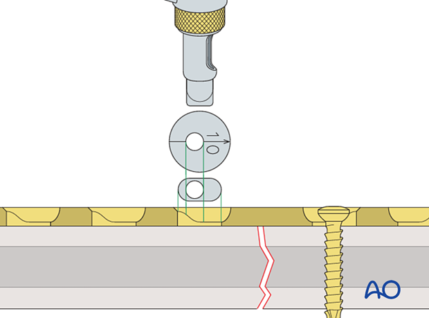 DCP drill guide with gold collar