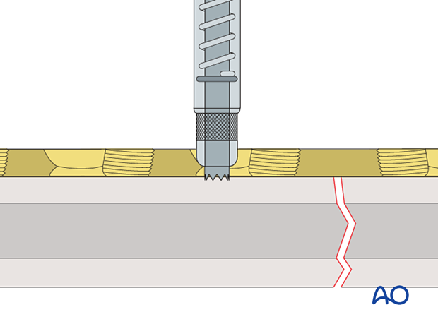 universal spring-loaded DCP drill guide