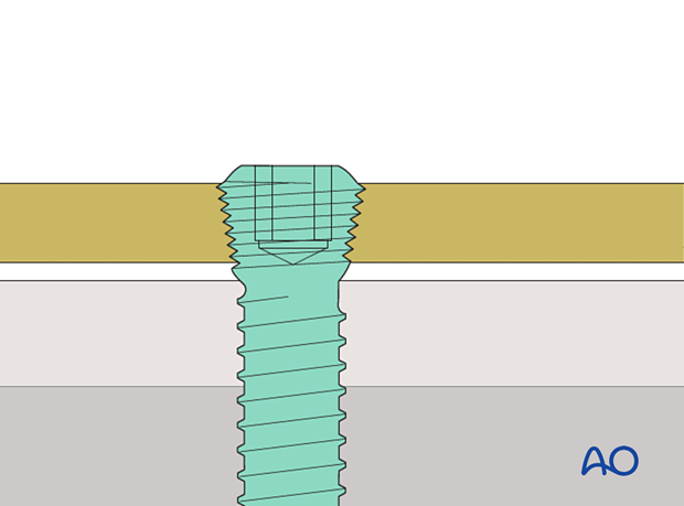 Locking head screw  inserted in a plate