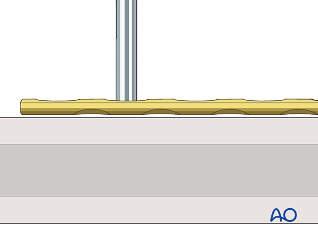 Insertion of drill guide