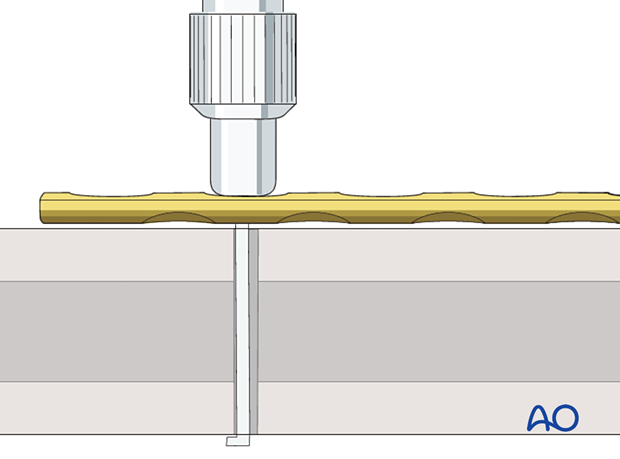 Determination of screw length