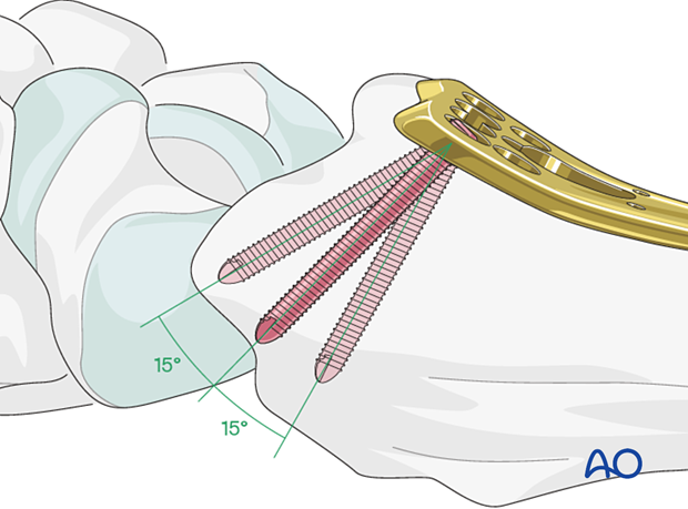 Screw insertion