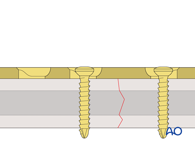 Screw insertion in compression mode