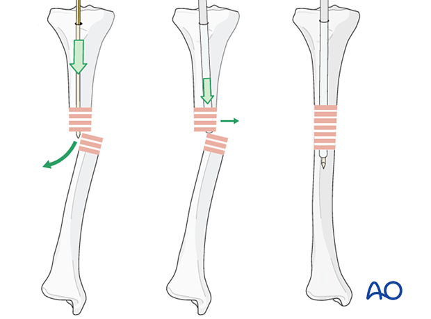 Use of aiming device to aid reduction adequate for guide wire to pass fracture site