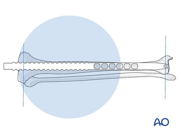 Determination of length using second guide wire