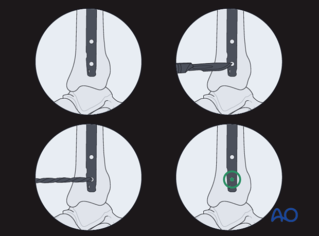 Distal locking