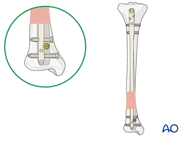 Poller screws