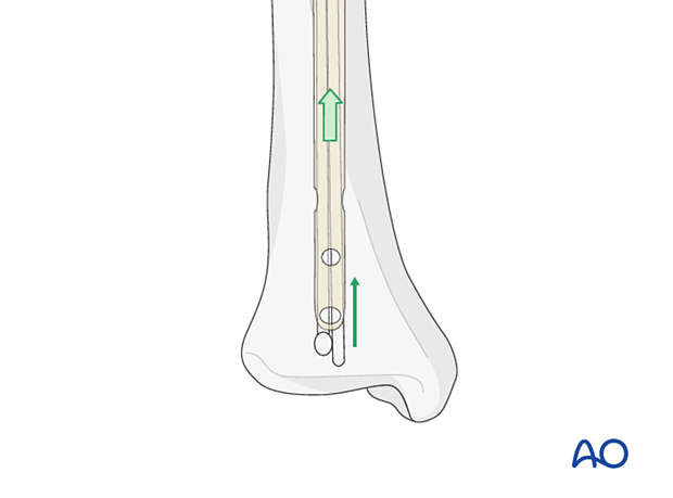 Insertion of additional straight guide wires