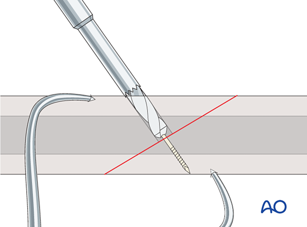 Insertion of cannulated screws