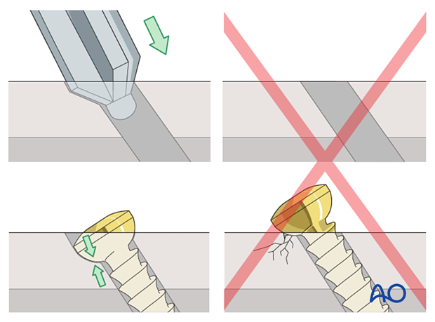 Countersinking