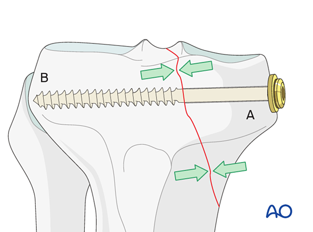 cancellous lag screws