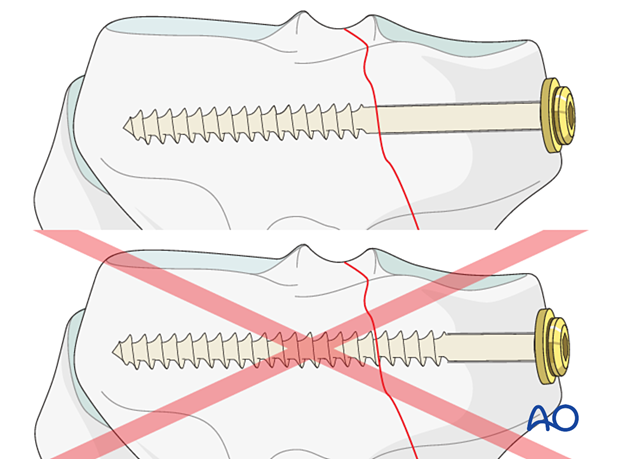 cancellous lag screws