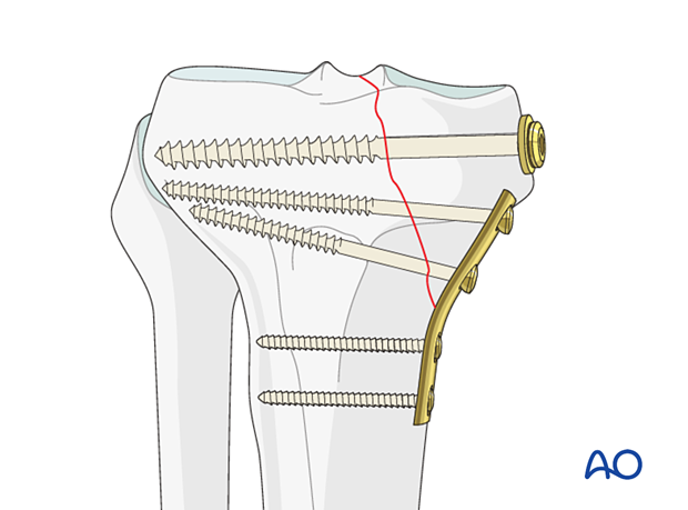 cancellous lag screws