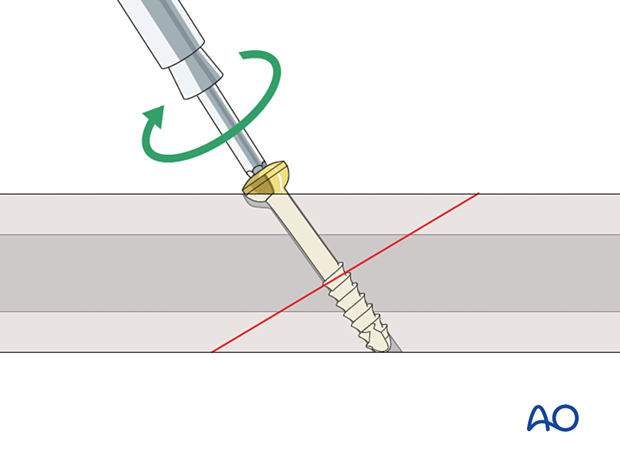 Insertion of self-tapping screw