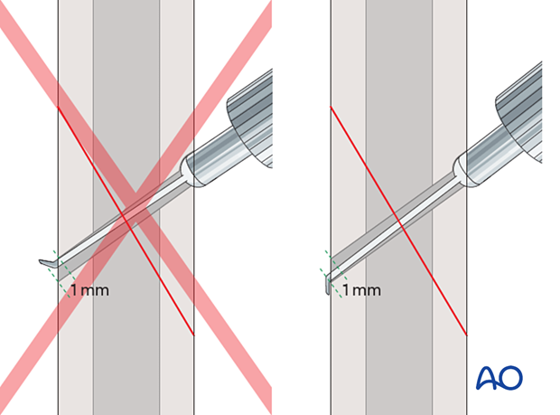 Determination of screw length