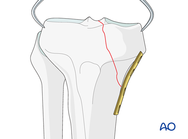 Lag screw insertion