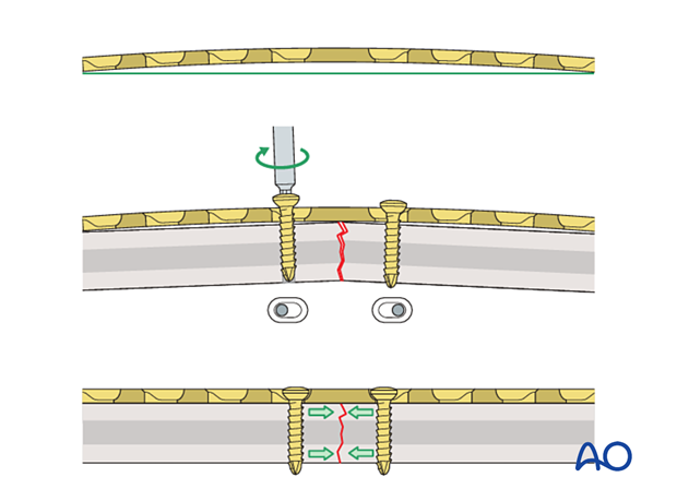 Effect of overbending the plate