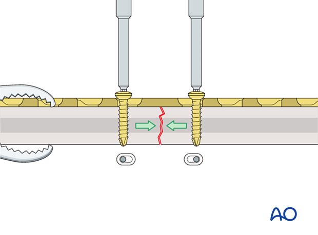 Insertion of second compression screw