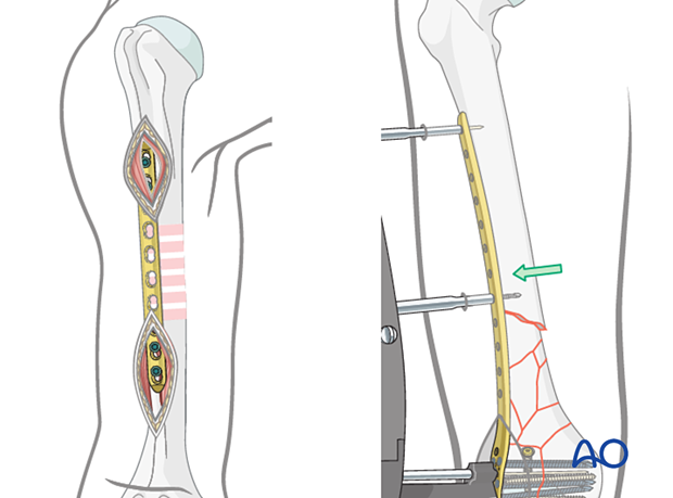 Minimally invasive techniques