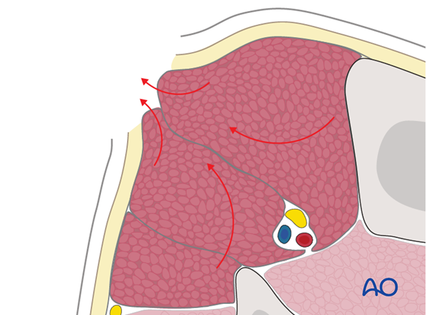 Treatment of compartment syndrome requires surgical release of the closed osteo-fascial compartment by wide and lengthy...