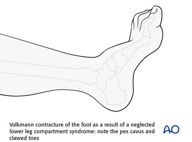 Muscle compartment syndrome is a relatively common occurrence in the osteofascial compartments of the lower leg. 