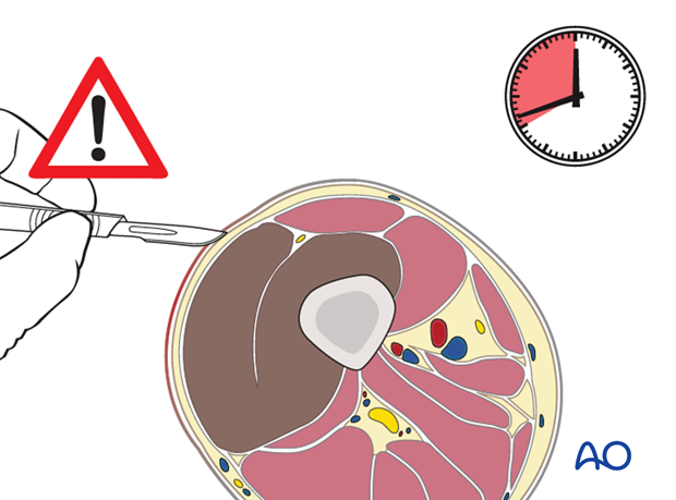 Where recognition of an established compartment syndrome is delayed for more than 8-10 hours after probable onset, ...