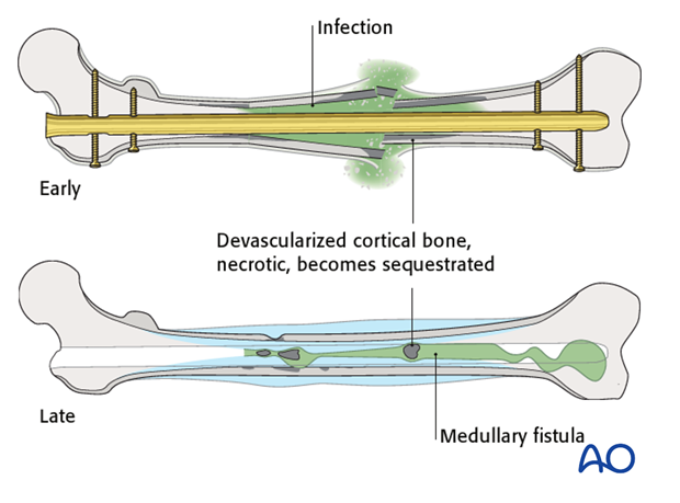 If a fracture site infection develops after intramedullary nailing, it is likely that the infection has ...