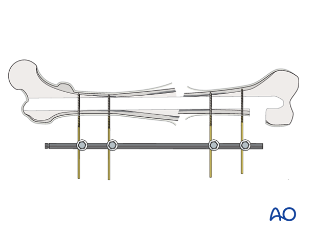 An external fixator should be applied for stability, if the fracture is not healed.