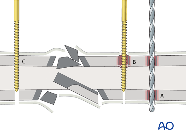 Mistakes in pin insertion for external fixation