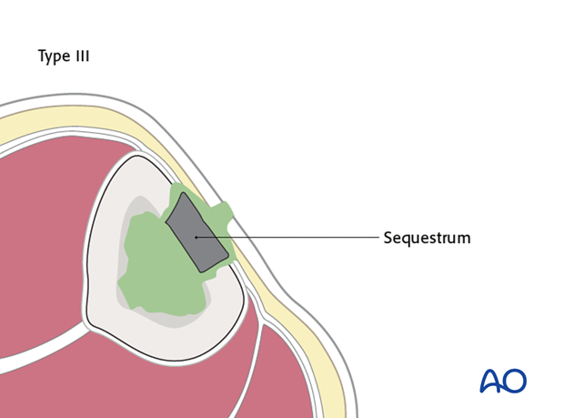 Localized, full-thickness osteomyelitis (type III)