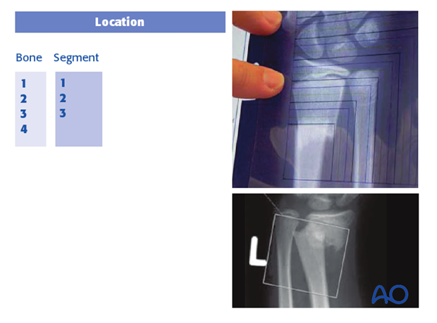 classification of childrens fractures