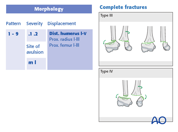 classification of childrens fractures