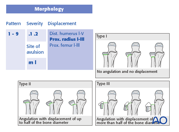 classification of childrens fractures