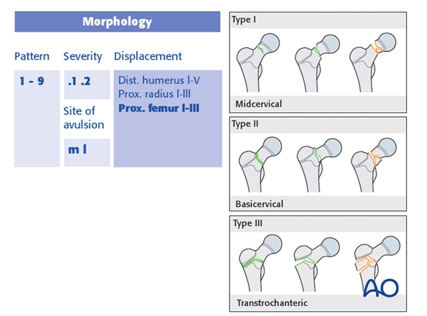 classification of childrens fractures