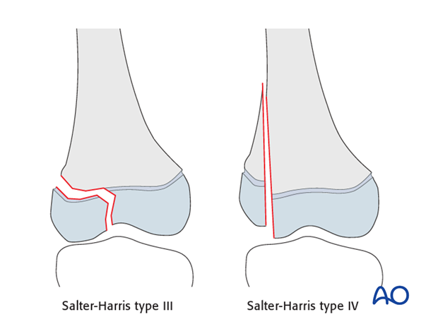 principles of nonoperative treatment of childrens fractures