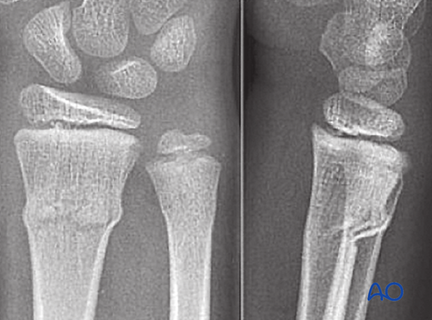 principles of nonoperative treatment of childrens fractures