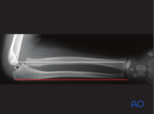 principles of nonoperative treatment of childrens fractures