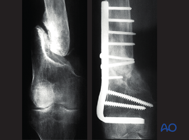 fractures in abnormal bone