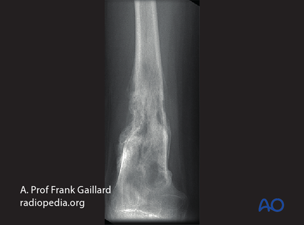 fractures in abnormal bone