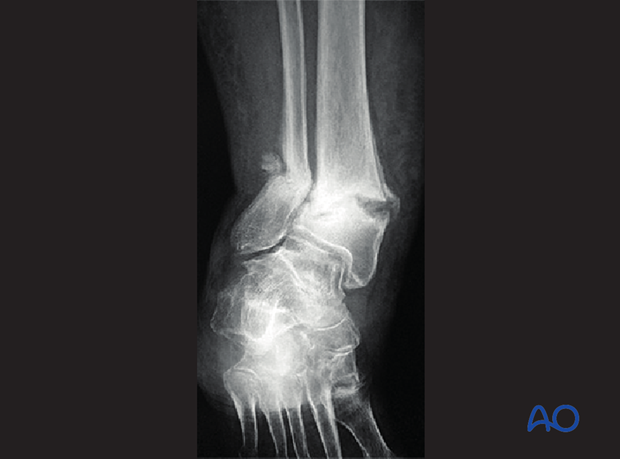 fractures in abnormal bone